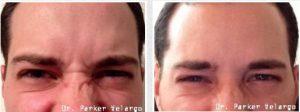 Botox To Bunny Lines, New Orleans By Dr. Parker Velargo