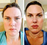 Botox Toxin With Doctor James M. Pearson, Beverly Hills Plastic Surgeon