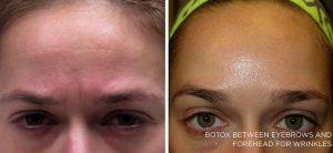 Botox Treatment At The Maryland Dermatology Laser, Skin And Vein Institute,Baltimore
