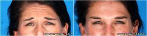 Botox Treatment By Gregory W. Pippin, M.D., F.A.A.C.S.,New Orleans