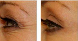 Botox Treatment Crow's Feet At Pur Skin Clinic,Seattle