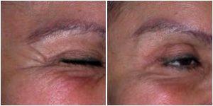 Botox Treatment Seattle