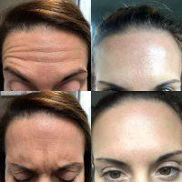 Botox With Dr. Kamran Khoobehi, Beverly Hills Plastic Surgeon