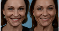 Botulinum Injection With Dr Yelena Frankel, Baltimore Plastic Surgeon