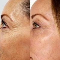 Botulinum Toxin By Doctor Asif Pirani, Toronto Plastic Surgeon