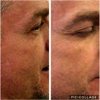 Botulinum Toxin Injections By Dr. Cynthia L. Mizgala, New Orleans Plastic Surgeon