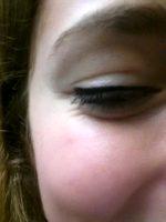 Botulinum Toxin Injections With Doctor Donald B. Yoo, Beverly Hills Plastic Surgeon