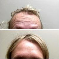 Botulinum Toxin Injections With Dr. Zoran Potparic, Fort Lauderdale Plastic Surgeon