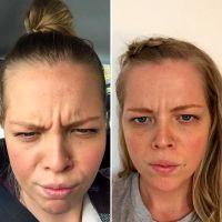 Botulinum Toxin With Dr Justin Harper, Fort Lauderdale Plastic Surgeon