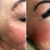 Cheap Botox Fort Lauderdale