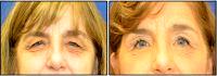 Cosmetic Botox Injections By Dr Sean R. Weiss, New Orleans Plastic Surgeon