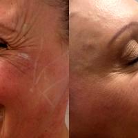 Doctor Ali Sadeghi, New Orleans Plastic Surgeon Botox OnabotulinumtoxinA Injection