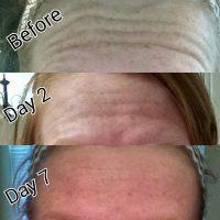 Doctor Daniel Fowler, Knoxville Plastic Surgeon Botox Injection Before And Day 2-7 After