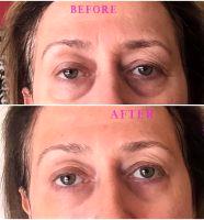 Doctor David B. Reath, Knoxville Plastic Surgeon - Botulinum Toxin Injections