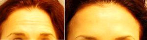 Doctor David Shahram Mashhadian, MD, Beverly Hills Oral & Maxillofacial Surgeon - 42 Year Old Woman Treated With Botox