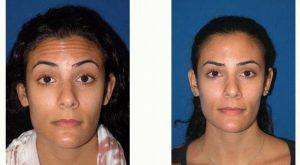 Doctor John Diaz, MD, Beverly Hills Plastic Surgeon - 32 Year Old Woman Treated With Botox