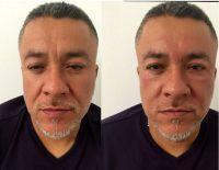 Doctor Kristin J. Tarbet, Seattle Plastic Surgeon Botulinum Toxin Injections