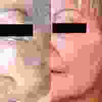 Doctor Oppenheimer Plastic Surgery, Orlando Plastic Surgeon The Botox