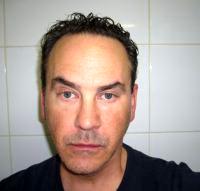 Dr Deirdre O'Boyle Hooper, New Orleans Plastic Surgeon Botulinum Toxin Photos Result