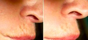 Dr Francis R. Palmer, III, MD, Beverly Hills Facial Plastic Surgeon - Botox