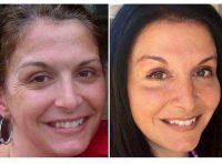 Dr Jaime S. Schwartz, Beverly Hills Plastic Surgeon Botulinum Toxin Injections