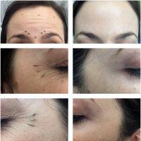 Dr James M. Ridgway, Seattle Plastic Surgeon Cosmetic Botox Injections