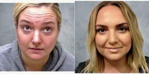 Dr Jimmy S. Firouz, MD, FACS, Beverly Hills Plastic Surgeon - 25 Year Old Woman Treated With Botox