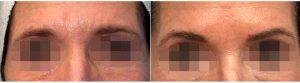 Dr Karen Beasley, MD, Baltimore Dermatologic Surgeon - 41 Year Old Woman Treated With Botox