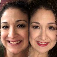 Dr Michael I. Echavez, Seattle Plastic Surgeon Botox Injection Treatment