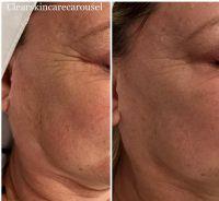 Dr Rodger Shortt, Toronto Plastic Surgeon Botulinum Toxin