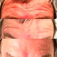 Dr. Elizabeth B.W. Anderson, Knoxville Plastic Surgeon Botox Type A