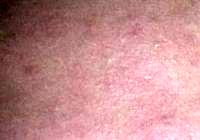 Dr. Jennifer Reichel, Seattle Plastic Surgeon Botox