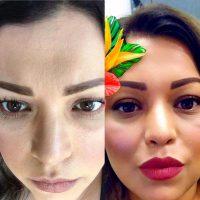 Dr. John M. Anastasatos, Beverly Hills Plastic Surgeon Botox Type A Photos