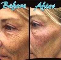 Dr. Mary P. Lupo, New Orleans Plastic Surgeon Botox Injection Procedure Patient Pictures Results