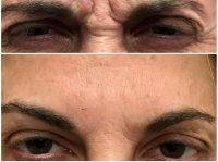 Dr. Michael Weinberg, Toronto Plastic Surgeon Cosmetic Botox Injections