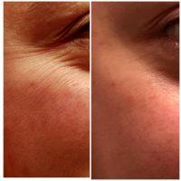 Dr. R. Stephen Mulholland, Toronto Plastic Surgeon OnabotulinumtoxinA