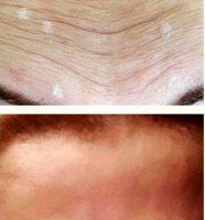 Dr. William Bruno, Beverly Hills Plastic Surgeon Botulinum Injection