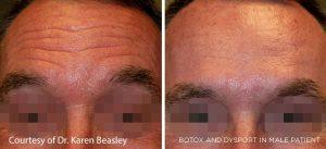 Dysport Injections For Male At At The Maryland Dermatology Laser, Skin And Vein Institute,Baltimore