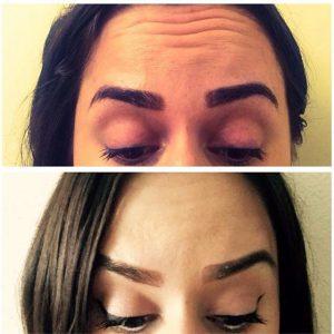 Dysport Treatment At The SkinSpirit Skin Care Clinic And Spa,Seattle