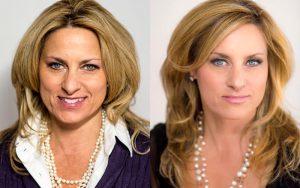 Dysport Treatment By Dr. Michele Shermak, MD,Baltimore