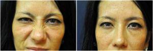 Dyspot Injections Glabellar Frown Line By Jennifer Reichel, MD,Seattle