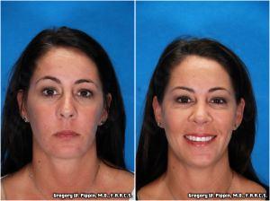 Elemination Brow Asymmetry With Botox By Gregory W. Pippin, M.D., F.A.A.C.S.,New Orleans