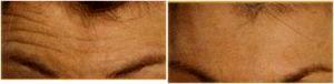 Elimination Of Wrinkles On The Forehead With Botox By Dr. Jacob, M.D,New Orleans
