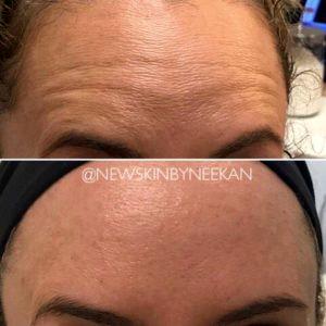 Flown Lines Treatment With Botox By Dr. Gary Motykie,M.D.,Beverly Hills