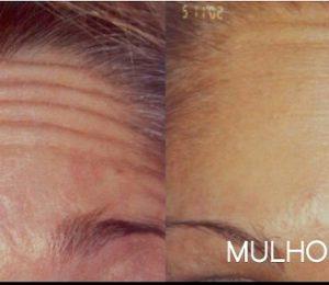 Forehead Wrikles Treated With Botox By Robert Stephen Mulholland, M.D.,Toronto
