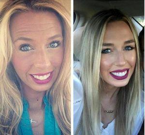 Forehead Wrinkles Correction By Brooke Bentley, FNP,Knoxville