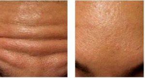 Forehead Wrinkles With Botox Of Real Patients Treated By Pur Skin Clinic Medical Providers,Seattle