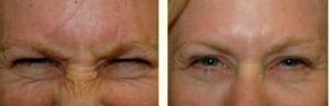 Glabella Botox Injections B YDr. Greenberg,M.D.,Orlando