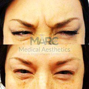 Glabellar Frown Line Treated With Botox By Dr. Rey Bello, MD,Knoxville