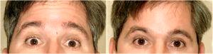 Here Is A 43-year-old Man Before And After Botox By Dr. Reath,MD,Knoxville